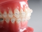 Preview: Agility™ Ceramic, Brackets individuales, MBT* .018"