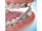 Preview: Forsus™ Class II Correction System, 1 Kit para pacientes, Push Rod X-Large (35 mm)