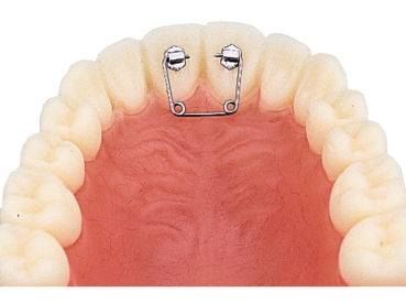 Muelle de diastema, kit