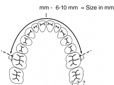 Arco de distalización molar, tamaño 5 (92 mm)