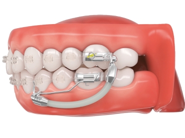 Flex Developer™ 2.0, longitud variable, 10 piezas para el lado derecho