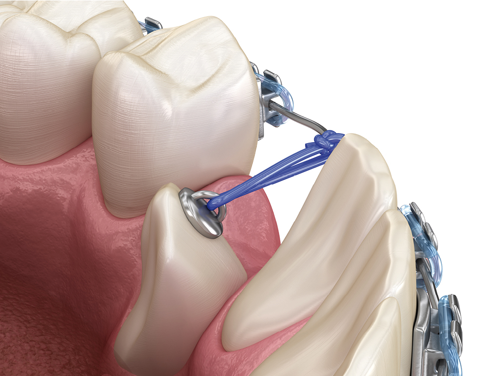 Hilos De Tracción Elásticos Orthodepot Tienda Para Clínicas Dentales Y De Ortodoncia 3801