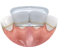 Fijación sencilla y precisa